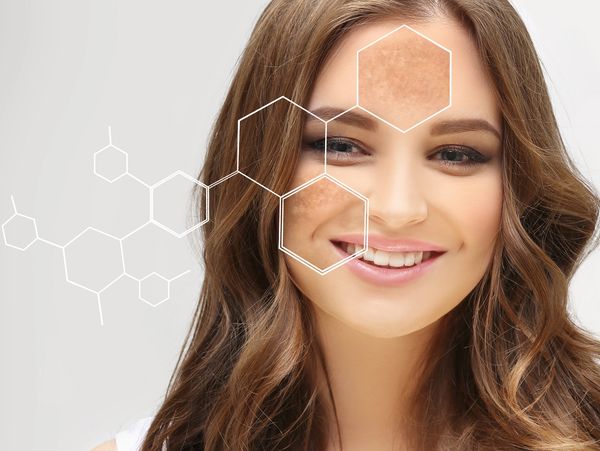 The image shows a woman with digitally highlighted areas of hyperpigmentation on her face