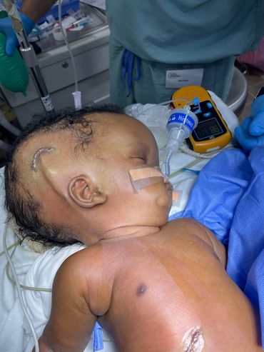 Infant with hydrocephaly having a shunt placed.