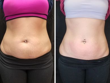 Before and after belly transformation comparison.