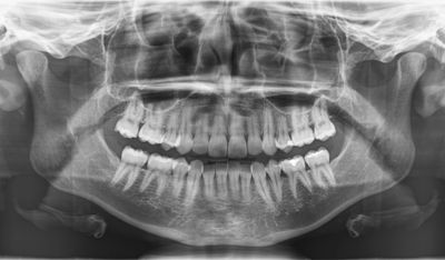 Panoramic radiograph of a dental patient at bohn dental in Hudsonville, MI.