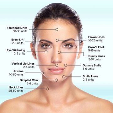 Woman's face with each area showing the number units needed for botox