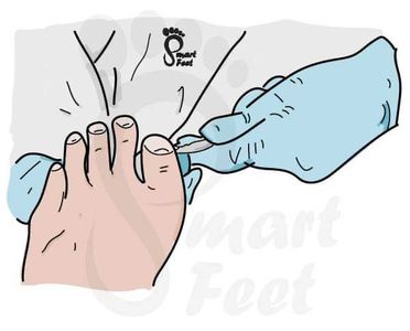 Smart-Feet Foot Care cutting toe nails, #northsomerset #smartfeetfootcar #advennturedesign