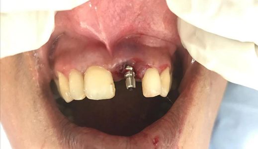 Mouth showing dental implant and missing front tooth.