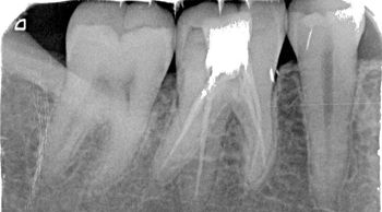 Dental X-ray showing molars with root canal treatment.