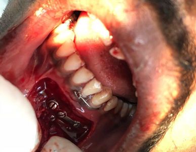 Post-surgical image showing metal plates and screws inside a patient's mouth.