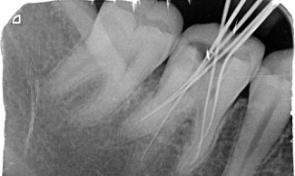 Dental X-ray showing root canal treatment with files in place.