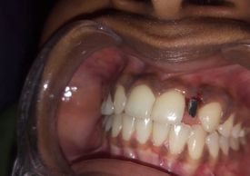 Close-up of mouth with dental implant site.
