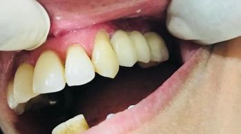 Close-up of a person's mouth showing teeth, some stained and yellowed.