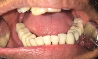 Close-up of open mouth showing teeth and dental tools.