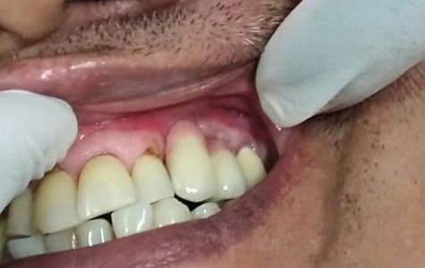 Close-up of a person's gums and teeth showing dental issues.