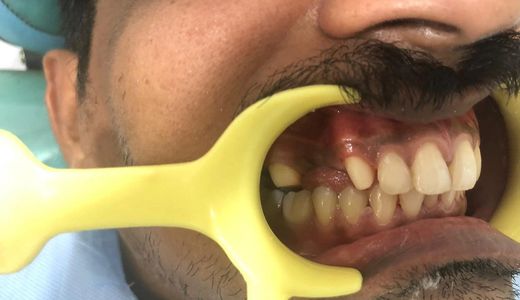Close-up of teeth with dental cheek retractor in place.