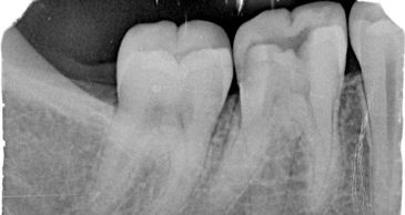 Dental X-ray showing teeth and roots.