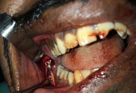 Oral surgery with dental tools inside a patient's mouth.