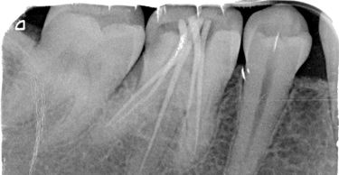 Dental X-ray showing root canal treatment.