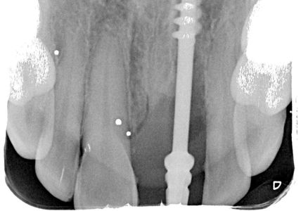 Implant X-Ray