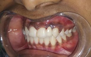 Close-up of a person's teeth and gums with a dental retractor in place.