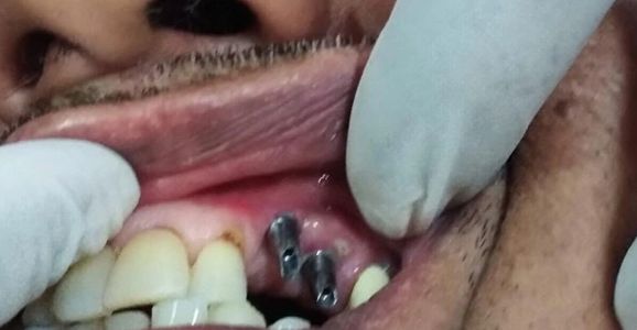 Close-up of dental implants in lower jaw.