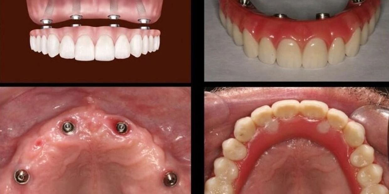 New Teeth in 1-Day or All-on-4