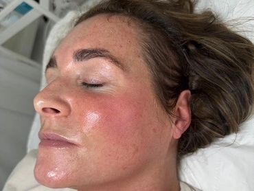 Woman with a flushed, glowing face lying on a bed, eyes closed.