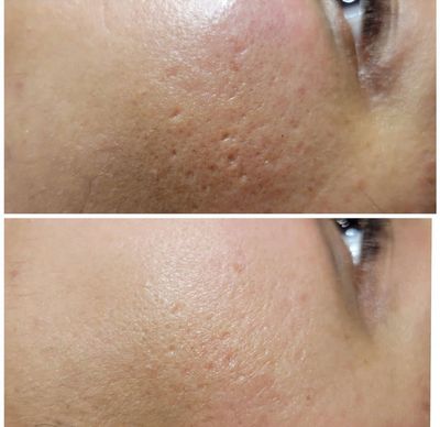 Nano needling, Rezenerate