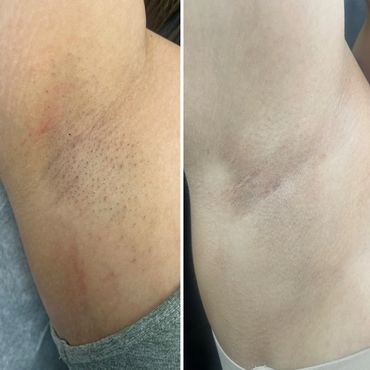 Laser hair removal for woman Braintree MA