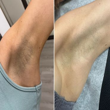Laser hair removal for woman underarms Braintree MA