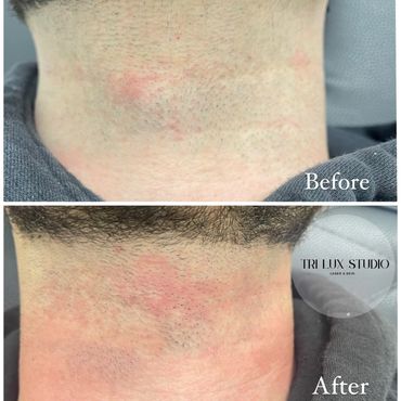 Laser hair removal for man Braintree MA