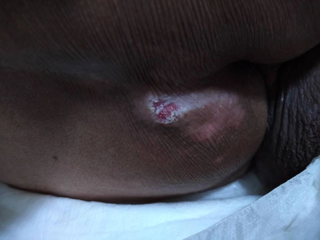 The acidity of the urine eventually burns several layers of the skin. Aiai Nursing Home Taipei Elder