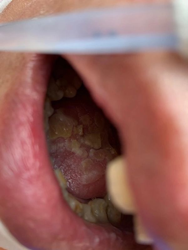 Taiwan Elder Abuse: Aiai Nursing Home Taipei has no regard for oral care.