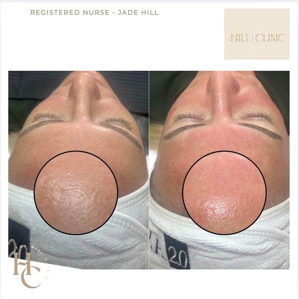 Microneedling using a CE marked device.