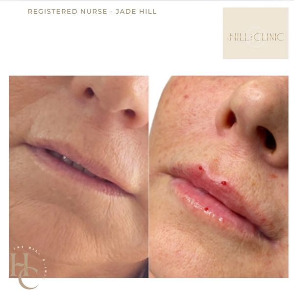 Lip filler using the premium Teoxane Kiss for the most natural enhancement.