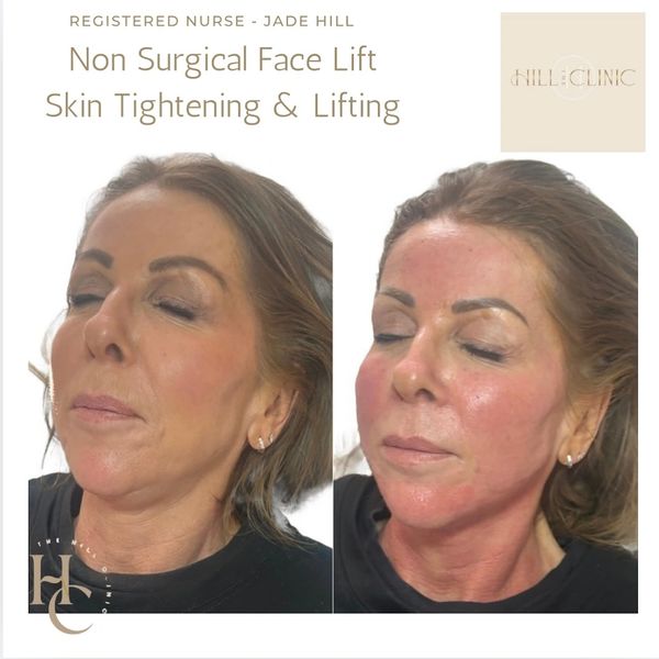 Skin tightening
