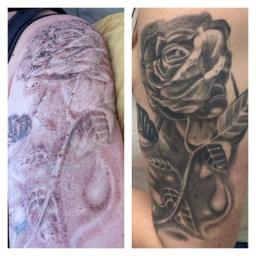 This pic is after one session of tattoo laser removal using Allwhite laser flash ink ndyag