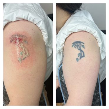 First session of tattoo laser removal using Aw3 flashink . The white frosting indicates that the las