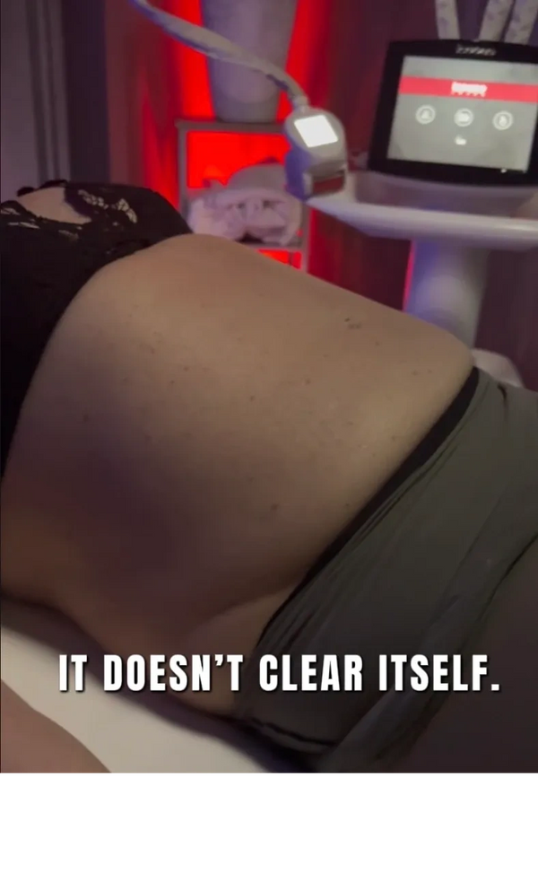 Chronic abdominal swelling that often leads clients in Boardman to seek lymphatic drainage therapy.