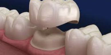 crown going on a tooth