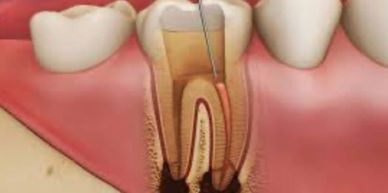 file going down a tooth root canal