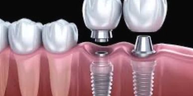 crowns going on dental implants