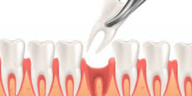 a tooth being extracted by a forceps