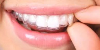 Invisalign clear aligner being put on teeth