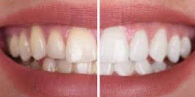 left side teeth are yellow and right side teeth are white after teeth whitening treatment