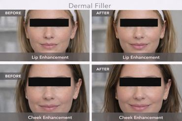 Lip and cheek enhancement results after dermal filler