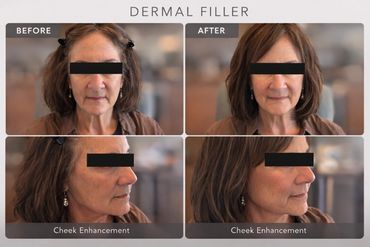 Before and after cheek enhancement results after dermal filler