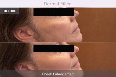 Cheek enhancement before and after results with dermal filler treatment