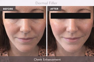Cheek enhancement before and after results with dermal filler treatment