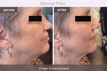 Cheek enhancement before and after results with dermal filler treatment