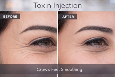 Crow's feet smoothing after xeomin injection