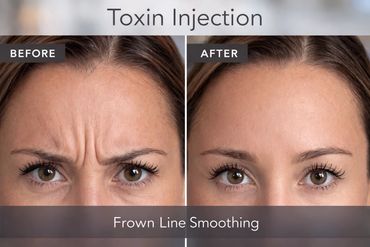 Frown line smoothing before and after results with xeomin injections