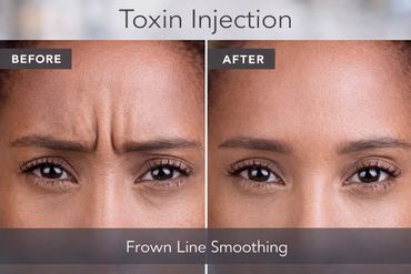 Frown line smoothing results after xeomin toxin injection