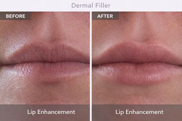 Subtle lip enhancement results after dermal filler